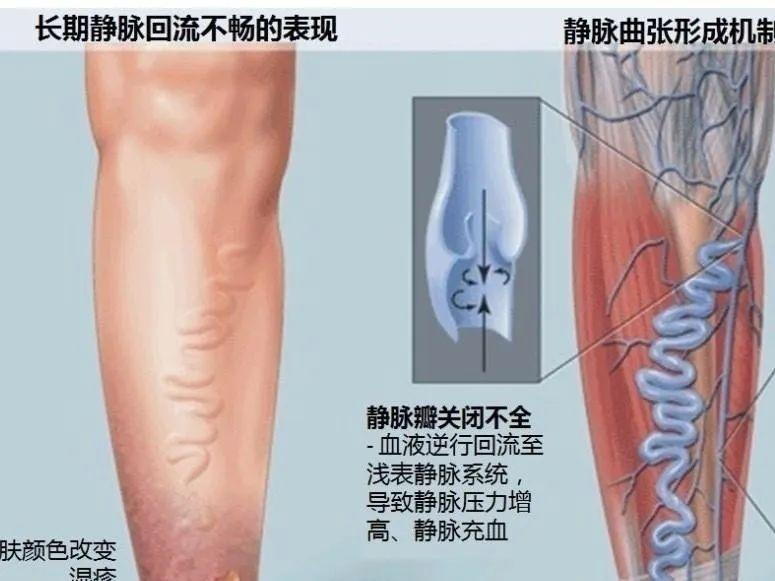 靜脈炎分級標準最新版詳解及應(yīng)用實踐